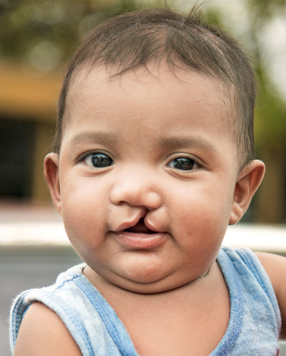 "He is going to be a beautiful boy" | Operation Smile