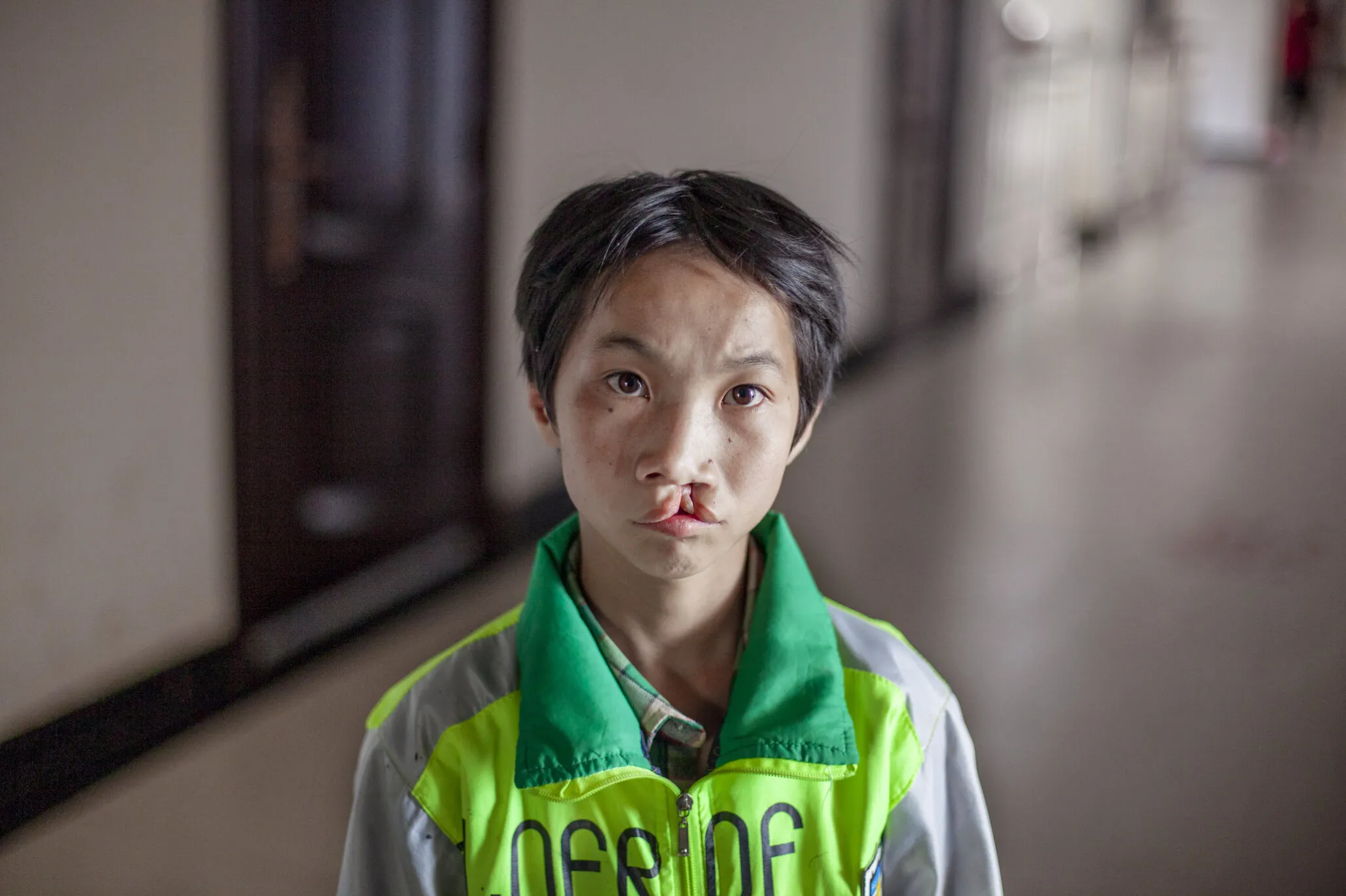 Thirteen-year-old Shijun, before surgery.