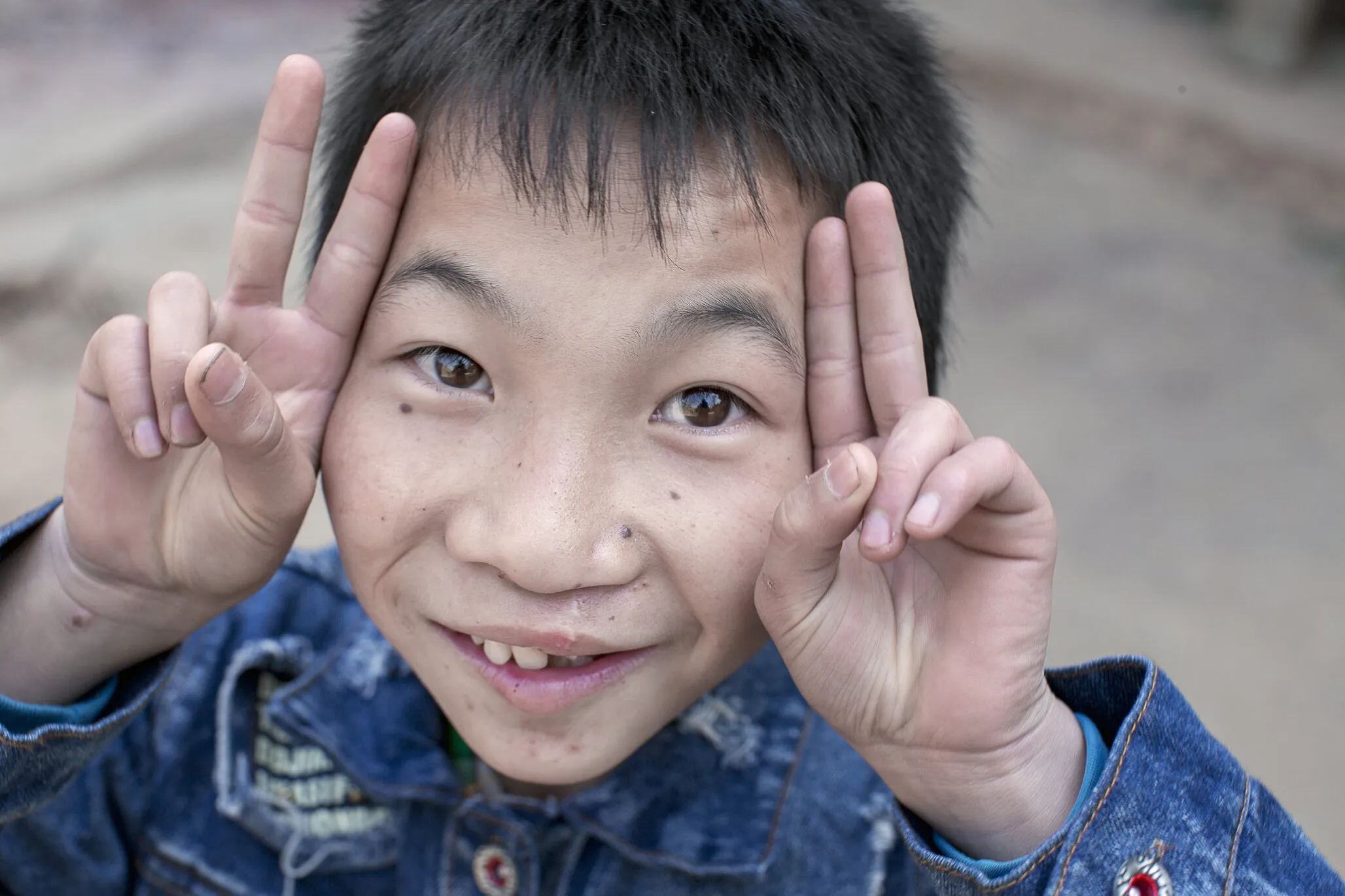 Shijun smiles wide one year after surgery.