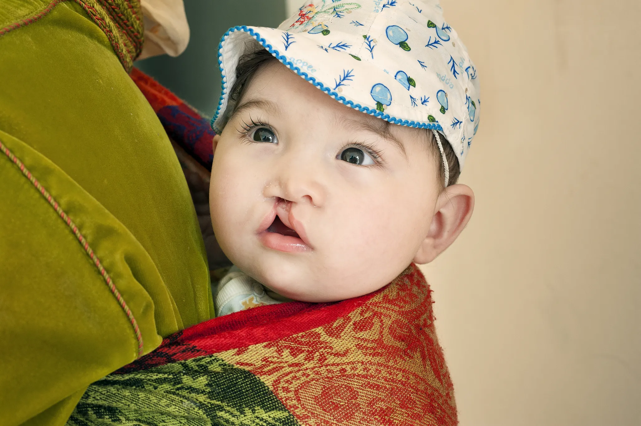 Six-month-old Rania, before surgery.