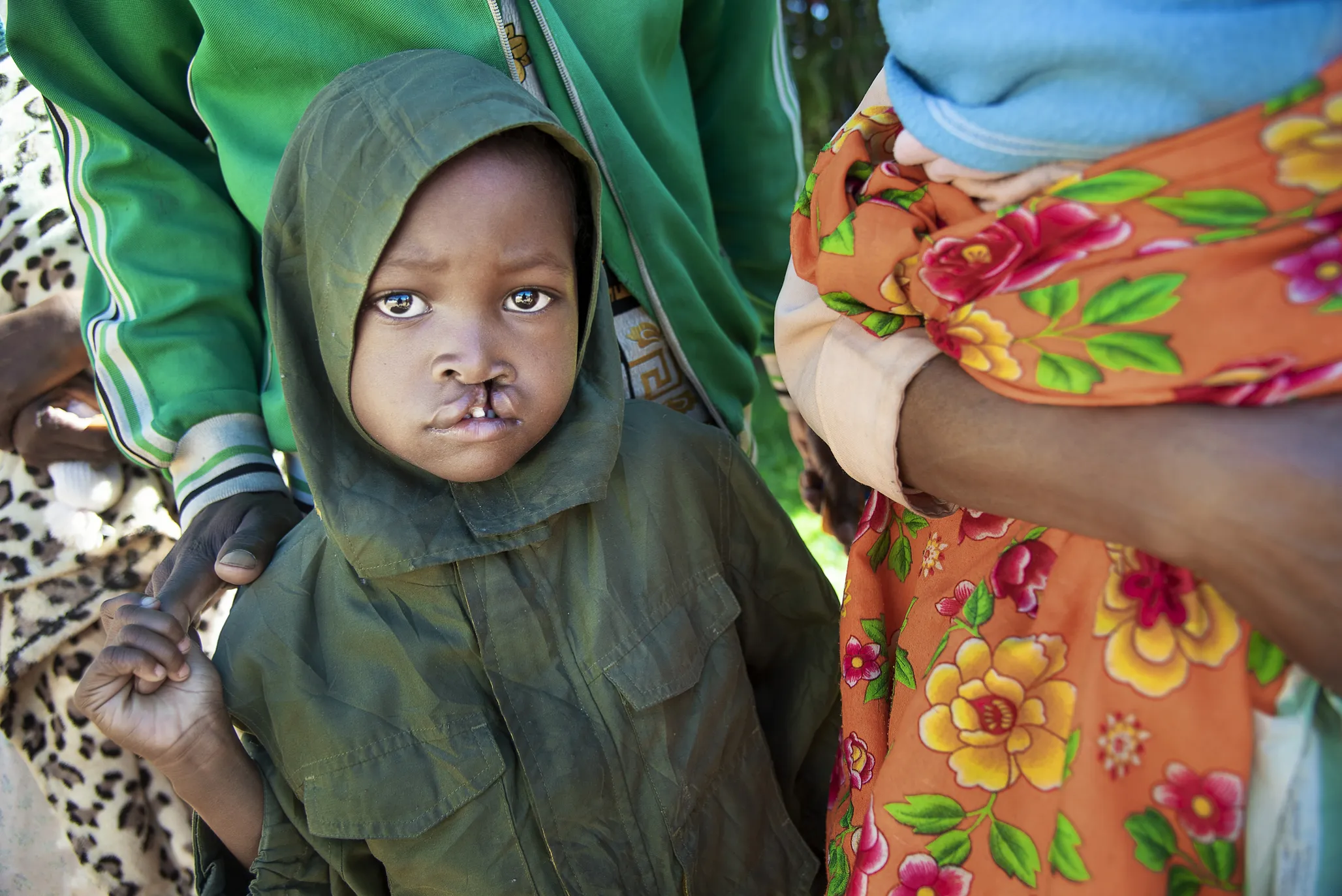 Five-year-old Genevieve waits with her father to learn whether or not she will receive surgery during the Antsirabe program.