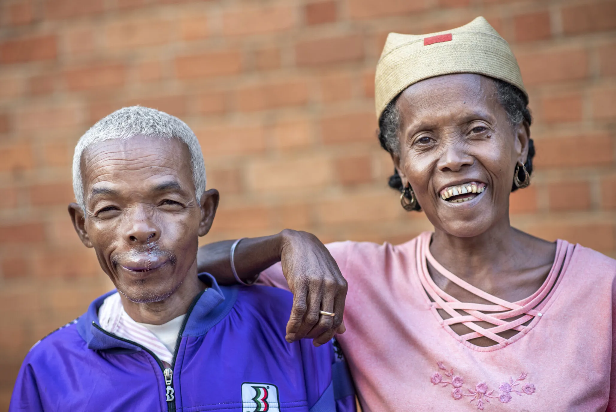 Alfred and his wife, Alice, share a special moment together, smiling wide after Alfred’s cleft surgery.