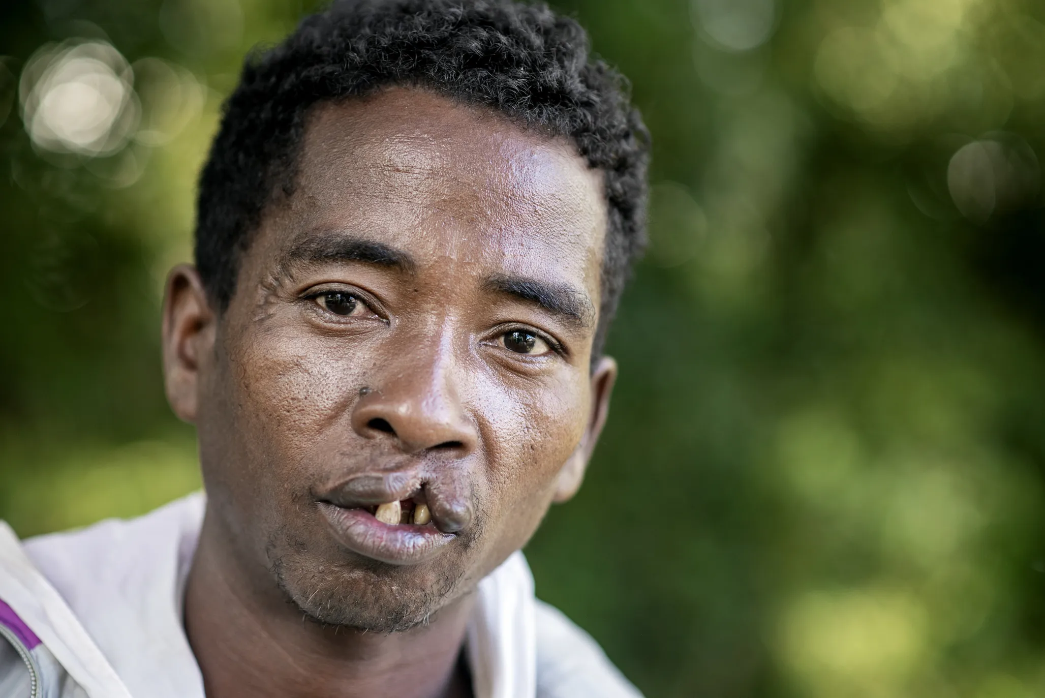 Zafilahy, 32 years old, before surgery.