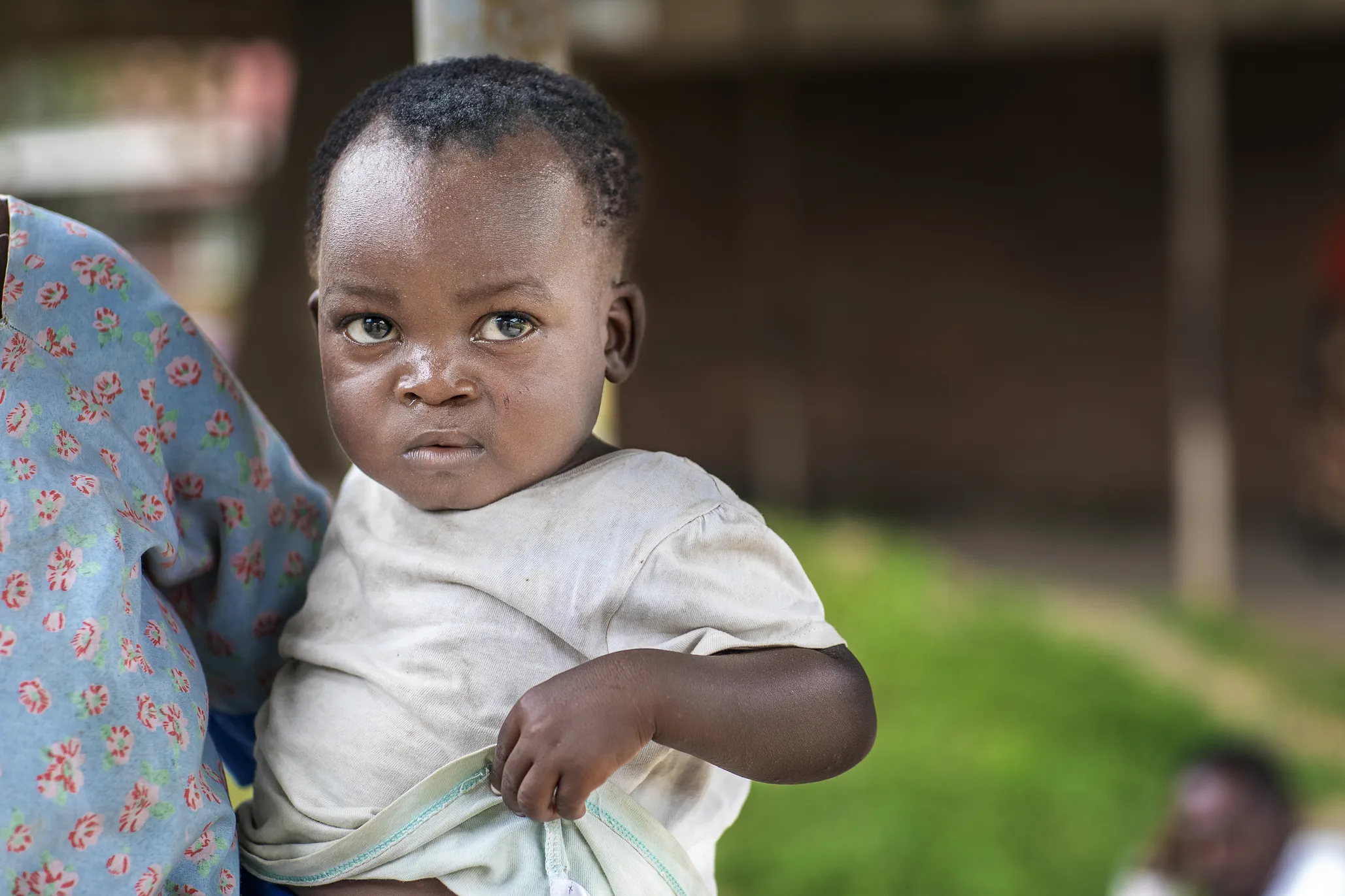 Sunday, one year after receiving cleft lip surgery.
