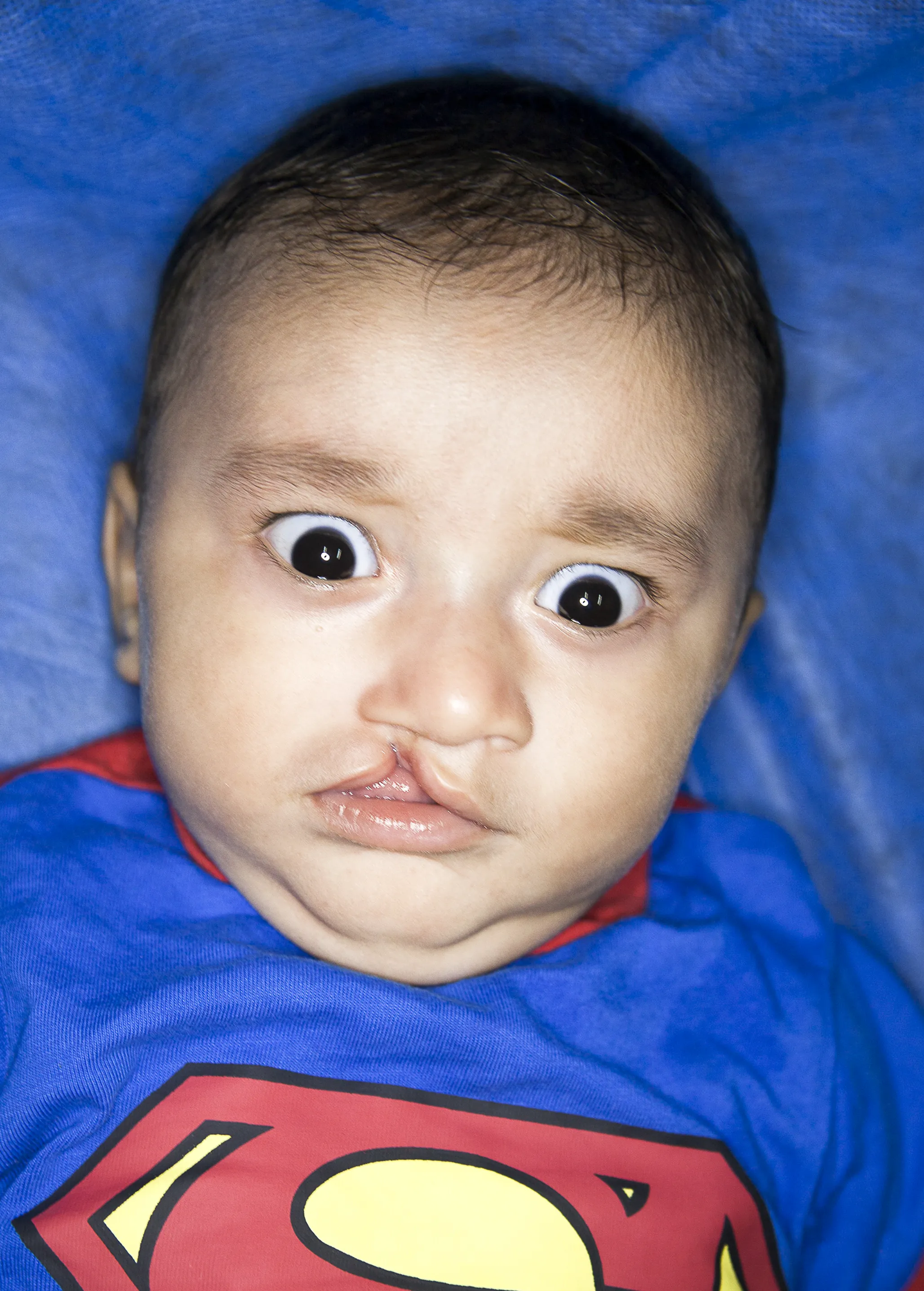 Lucas, before surgery.