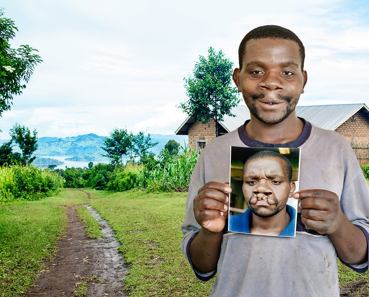Enok, wide smile, proudly shares his before cleft surgery