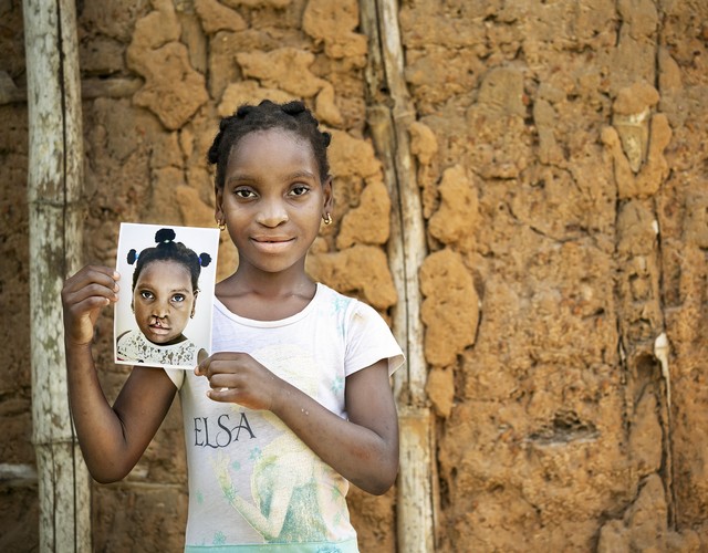 Four years after her cleft lip surgery, Ramata of Ghana holds a photo of her portrait from before she received surgery.