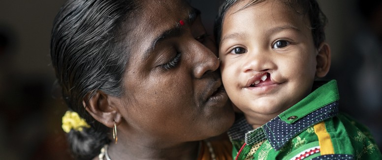 Child with a cleft lip being kissed by guardian, smiling into camera