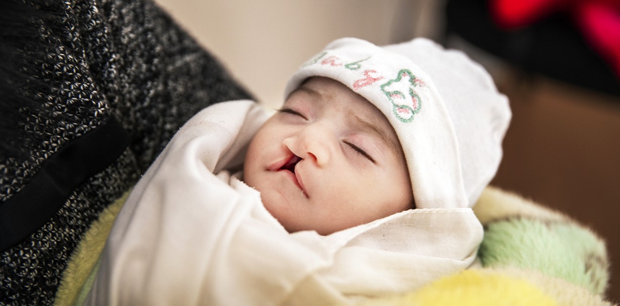 Due to her cleft palate, 1-month-old Janat arrived to our March 2020 program severely malnourished and on the verge of starvation. Photo: Jasmin Shah.