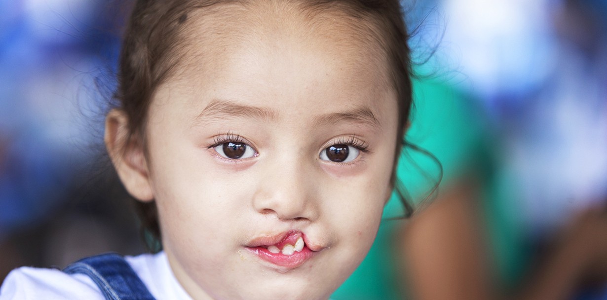 Three-year-old Zoe stares at the camera during screening day at an Operation Smile Honduras surgical program in 2022.