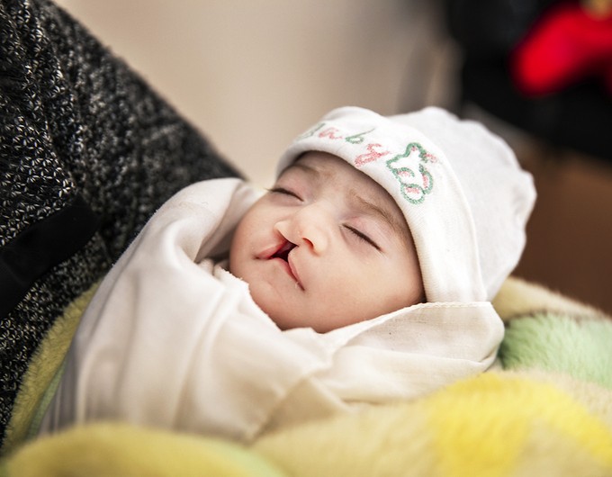 Due to her cleft palate, 1-month-old Janat arrived to our March 2020 program severely malnourished and on the verge of starvation. Photo: Jasmin Shah.