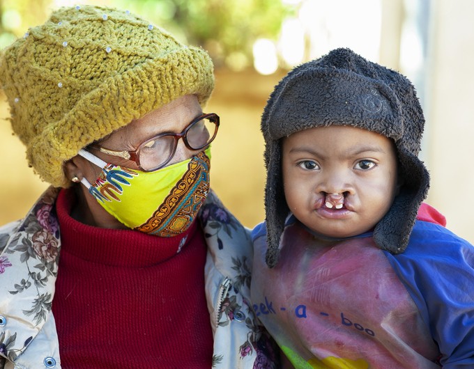 A young patient and their mother received nutritional support from Operation Smile Madagascar amid the COVID-19 pandemic. The patient, a toddler with an untreated bilateral cleft lip, is looking directly into the camera while being held by their caregiver, who is wearing a gold beanie, glasses and a bright yellow mask.
