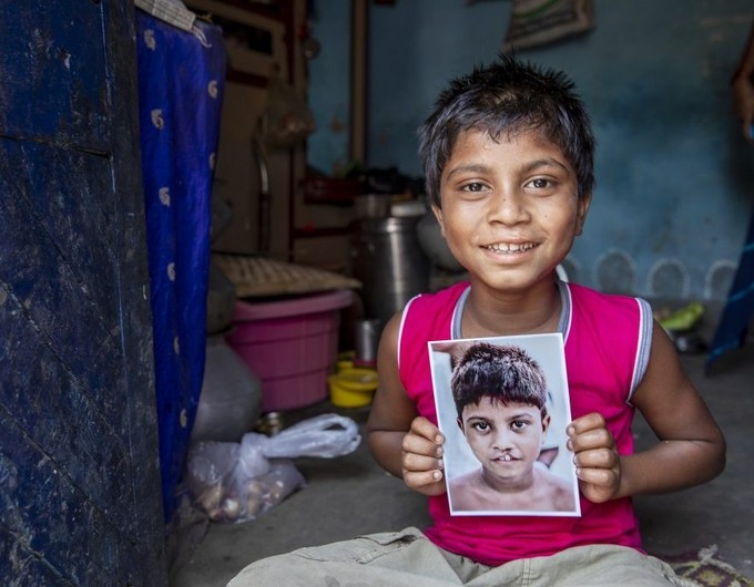 Smiling child in India holds a photo of what they looked like before cleft surgery