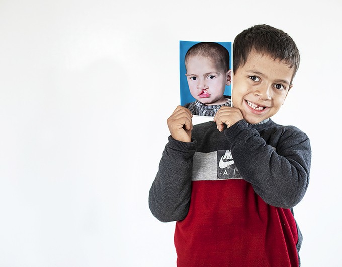 Haitam holds a photo of him before surgery as he smiles wide at the camera four years after receiving free life-changing cleft surgery. Photo: Lorenzo Monacelli.