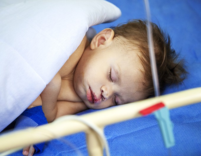 During a surgical program in Santarem, Brazil, Fredy sleeps soundly in his hospital bed following his cleft lip surgery.