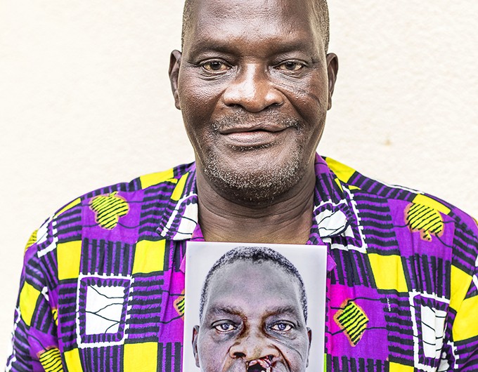 After living 66 years with an untreated cleft lip, Iddrisah shows off his new smile while holding a "before" image of himself two years after receiving surgery from Operation Smile Ghana. 
