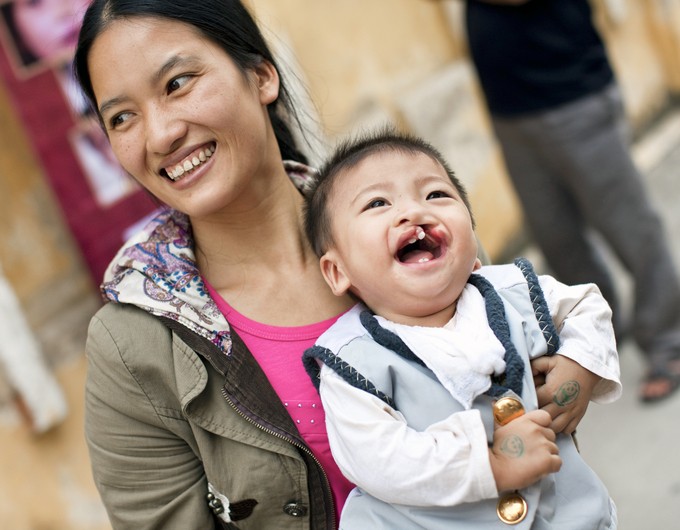 10-month-old Khiem smiles with his mother during a 2009 Operation Smile Vietnam surgical program.