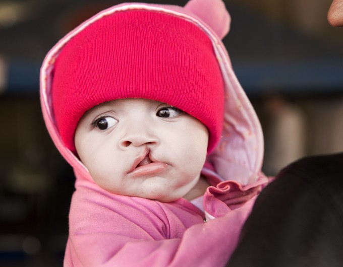 During a 2016 surgical program in Puebla, Mexico, 6-month-old Sabine wears a pink hoodie and a bright pink beanie on the second day of screening.