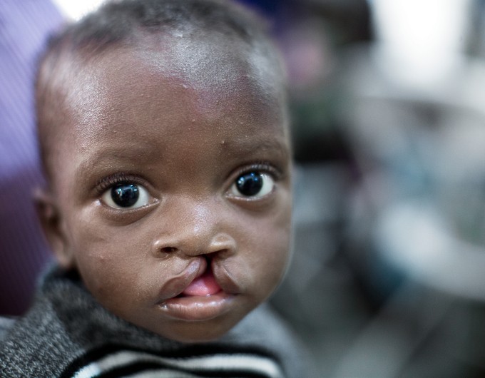 Eleven-month-old Moses looks head-on at the camera during screening at an Operation Smile Ghana surgical program. 