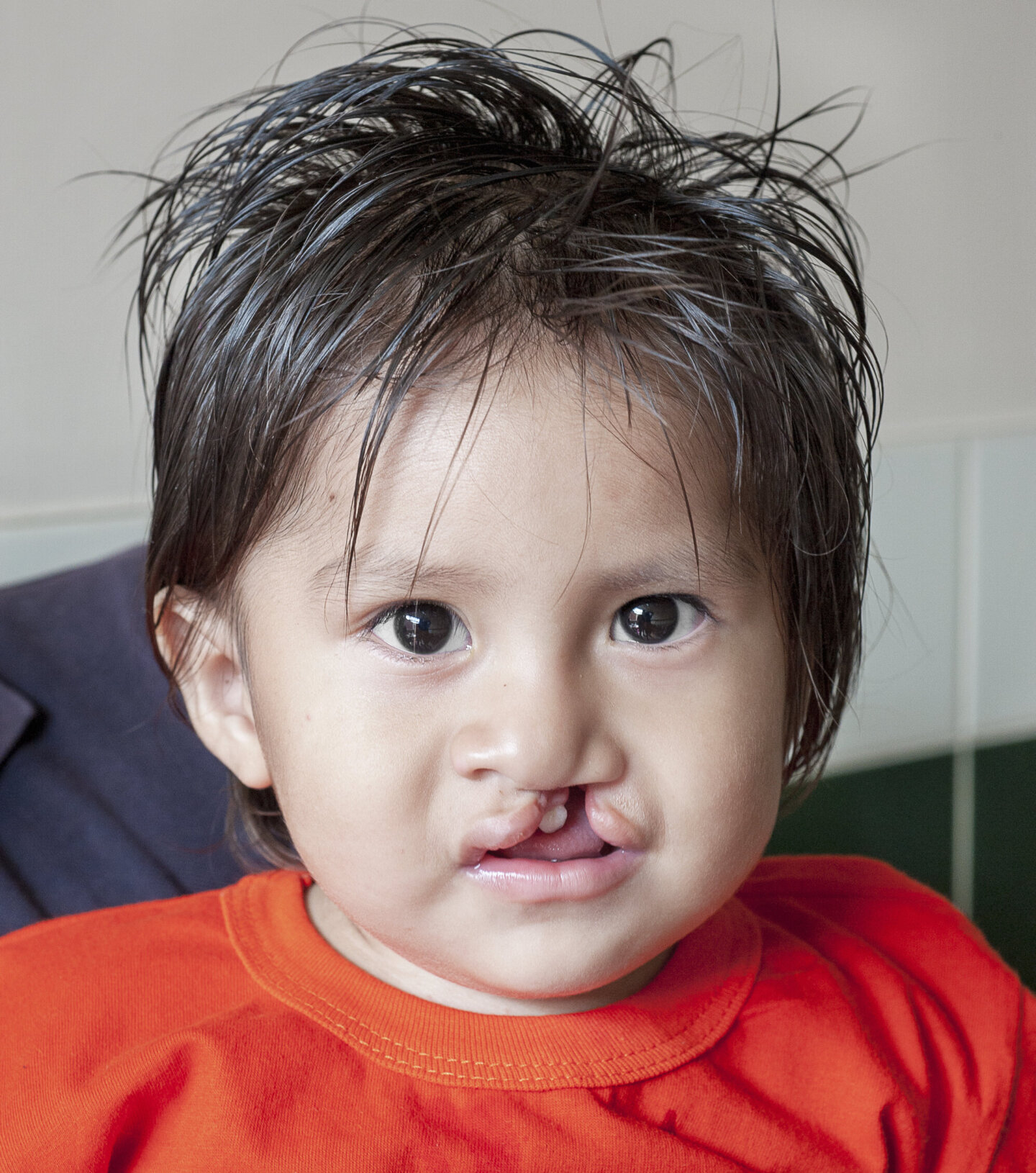 Damian, before surgery.