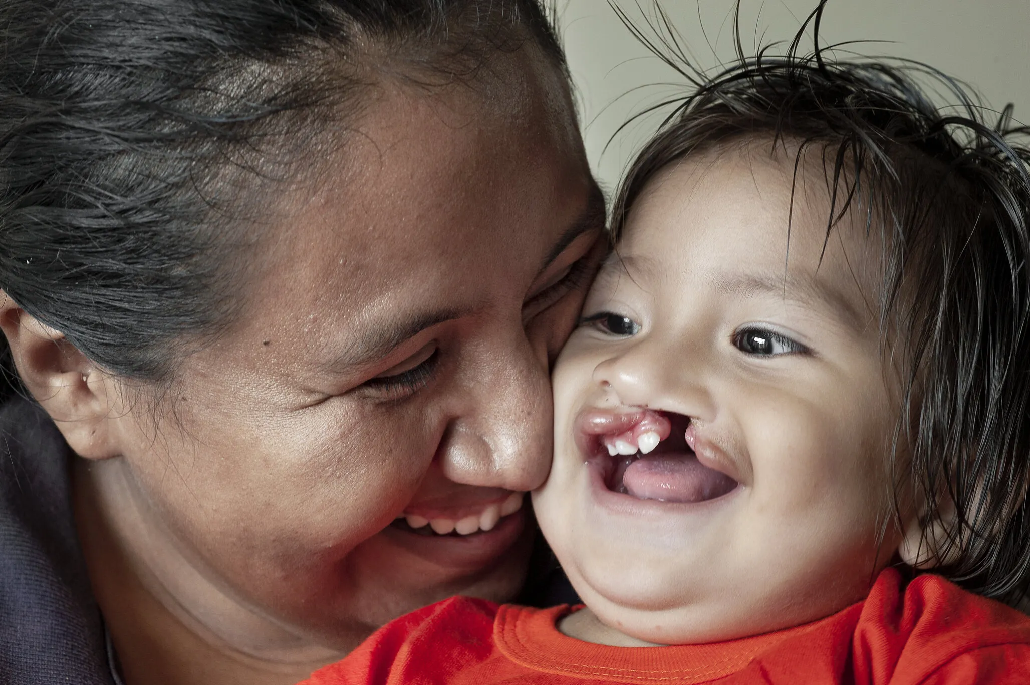 Here is 14-month-old Damian before surgery with his mom, Nora.