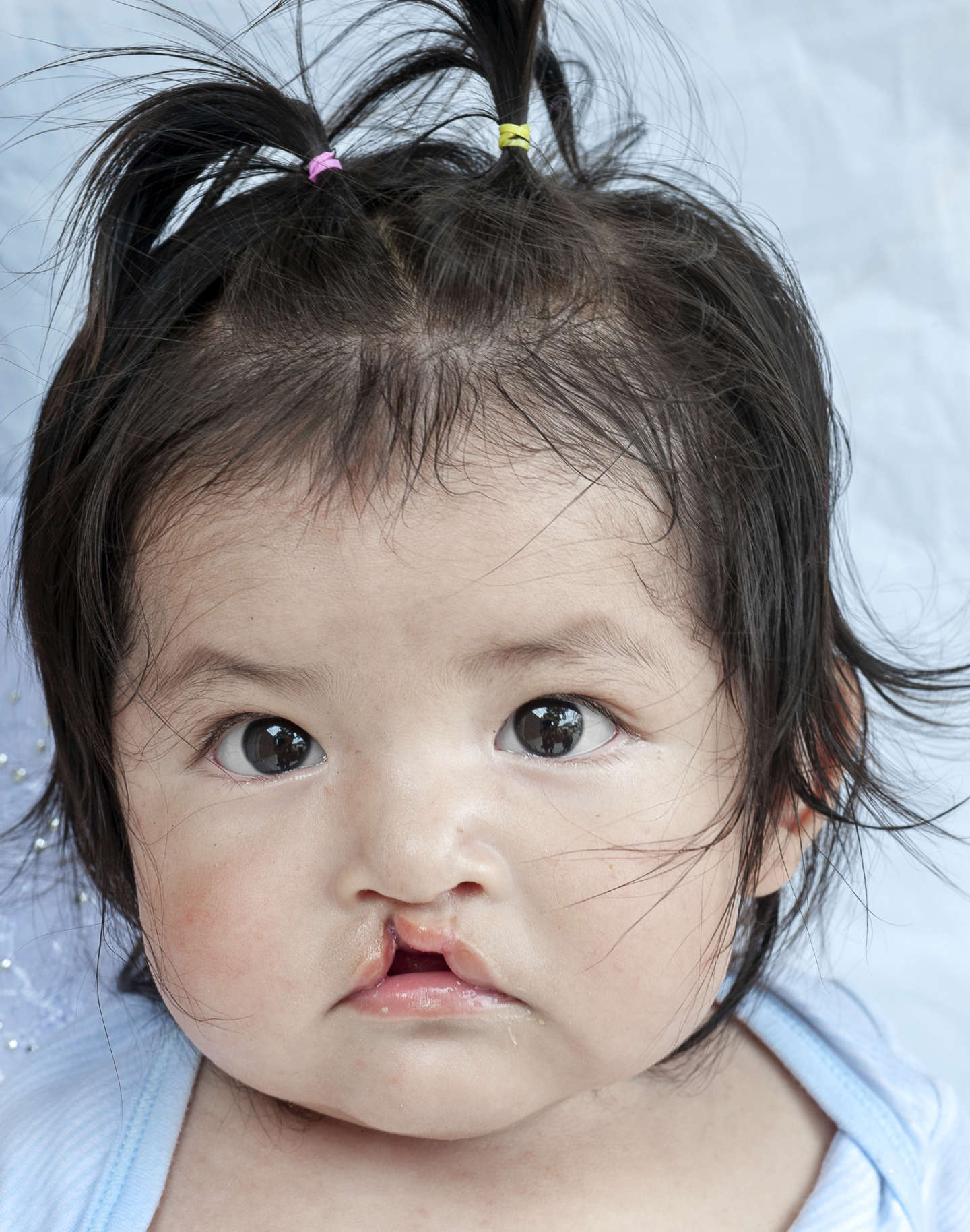 Annika, before surgery.