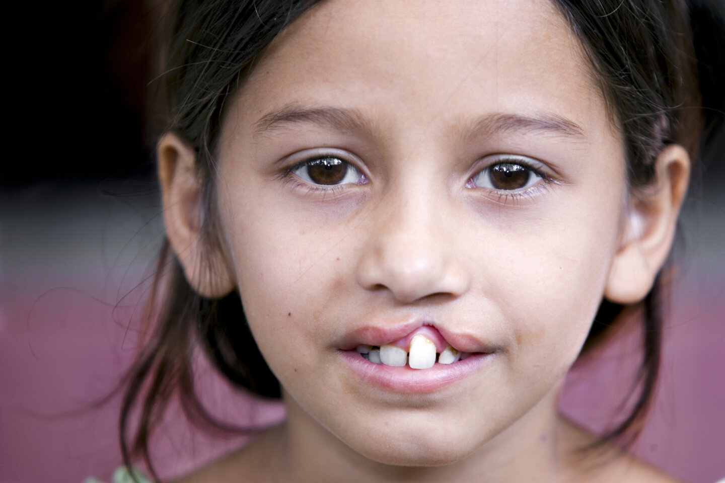 Eight-year-old Antonia during an Operation Smile Brazil surgical program to Fortaleza.