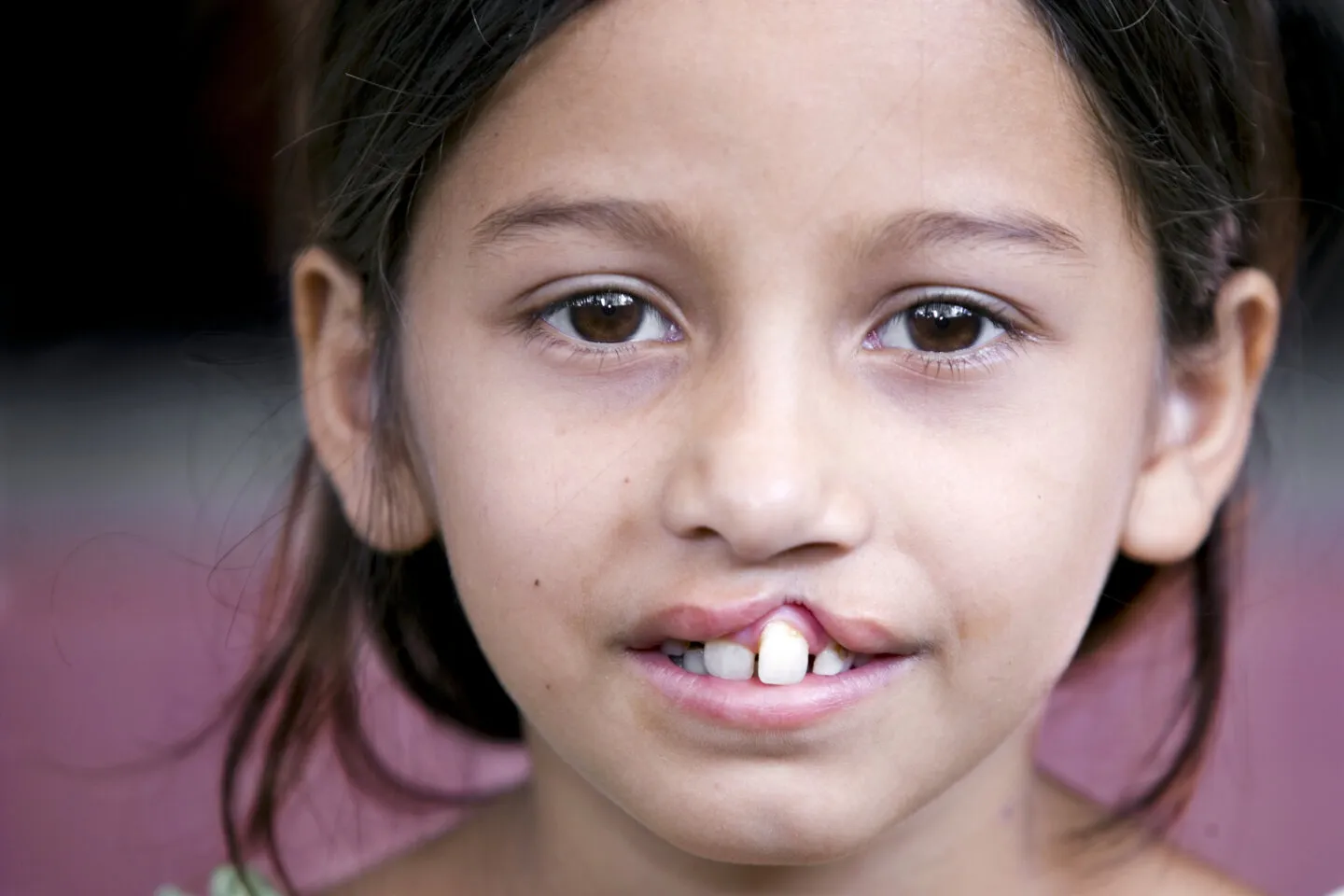 Eight-year-old Antonia during an Operation Smile Brazil surgical program to Fortaleza.