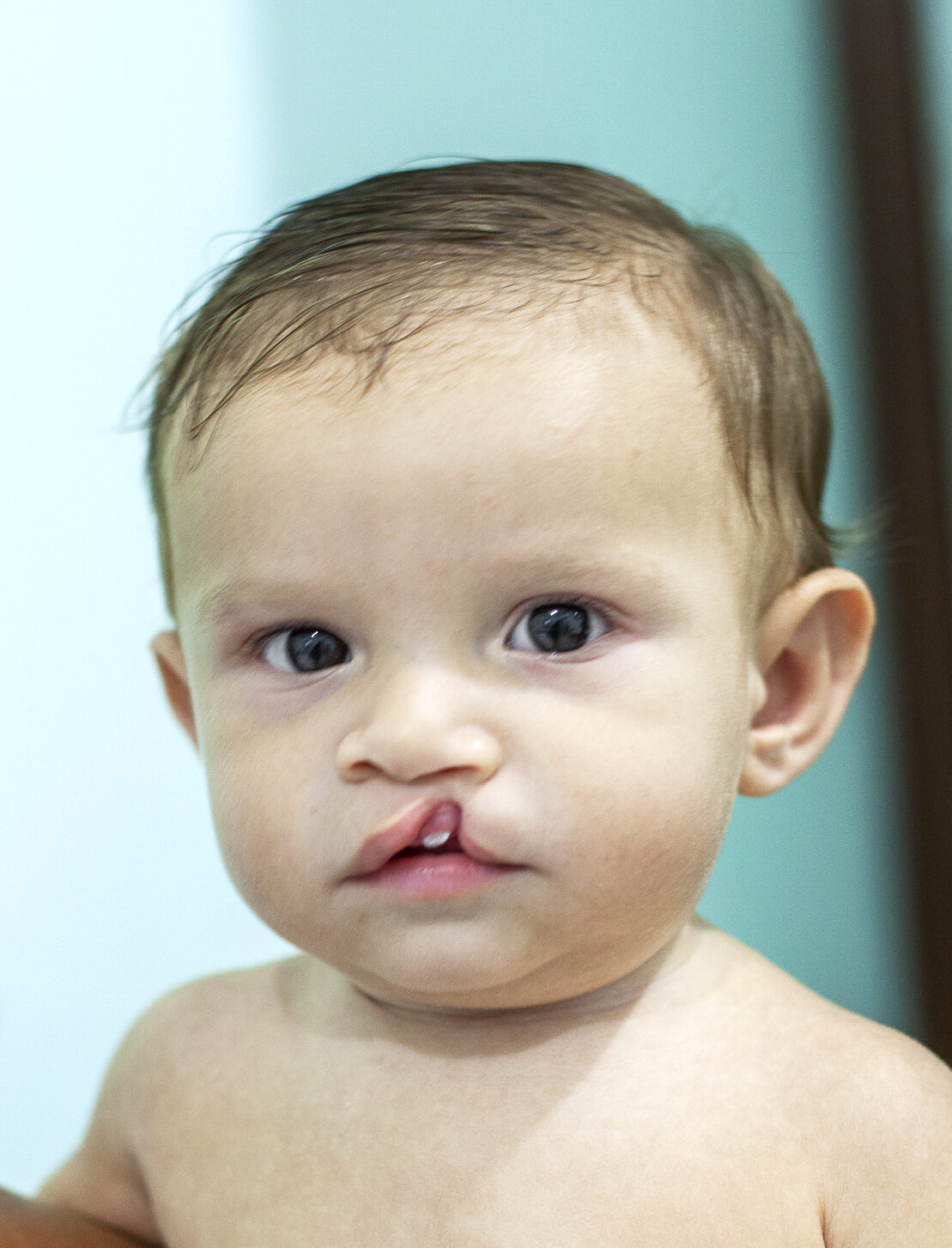 Fredy, before surgery.
