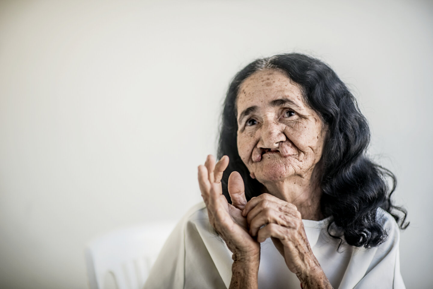 In 2017, 67-year-old Dona Maria received surgery during an Operation Smile Brazil surgical program.