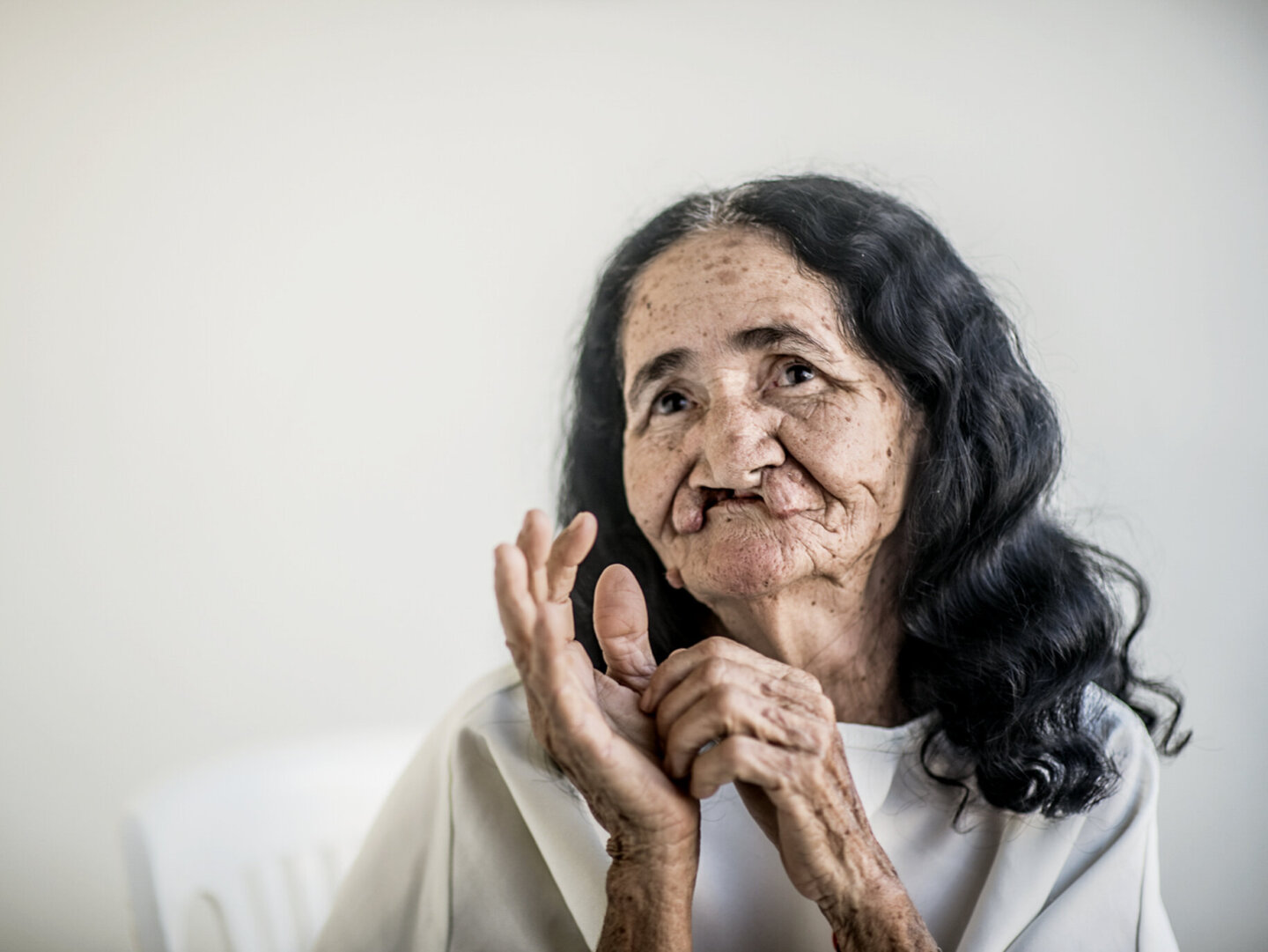 In 2017, 67-year-old Dona Maria received surgery during an Operation Smile Brazil surgical program.