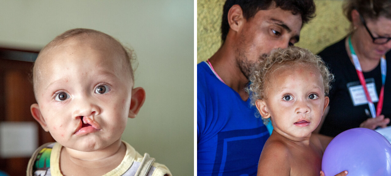 Jhone, before and after surgery.