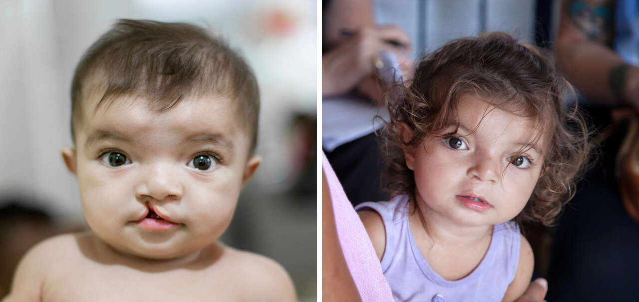Lorrane, before and after surgery.
