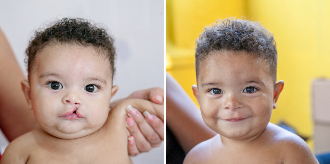 Wesilyn, before and after surgery.