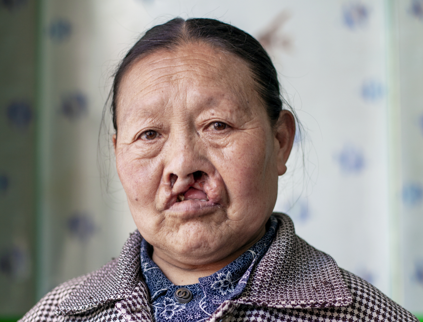 Qi Xiu, before surgery.