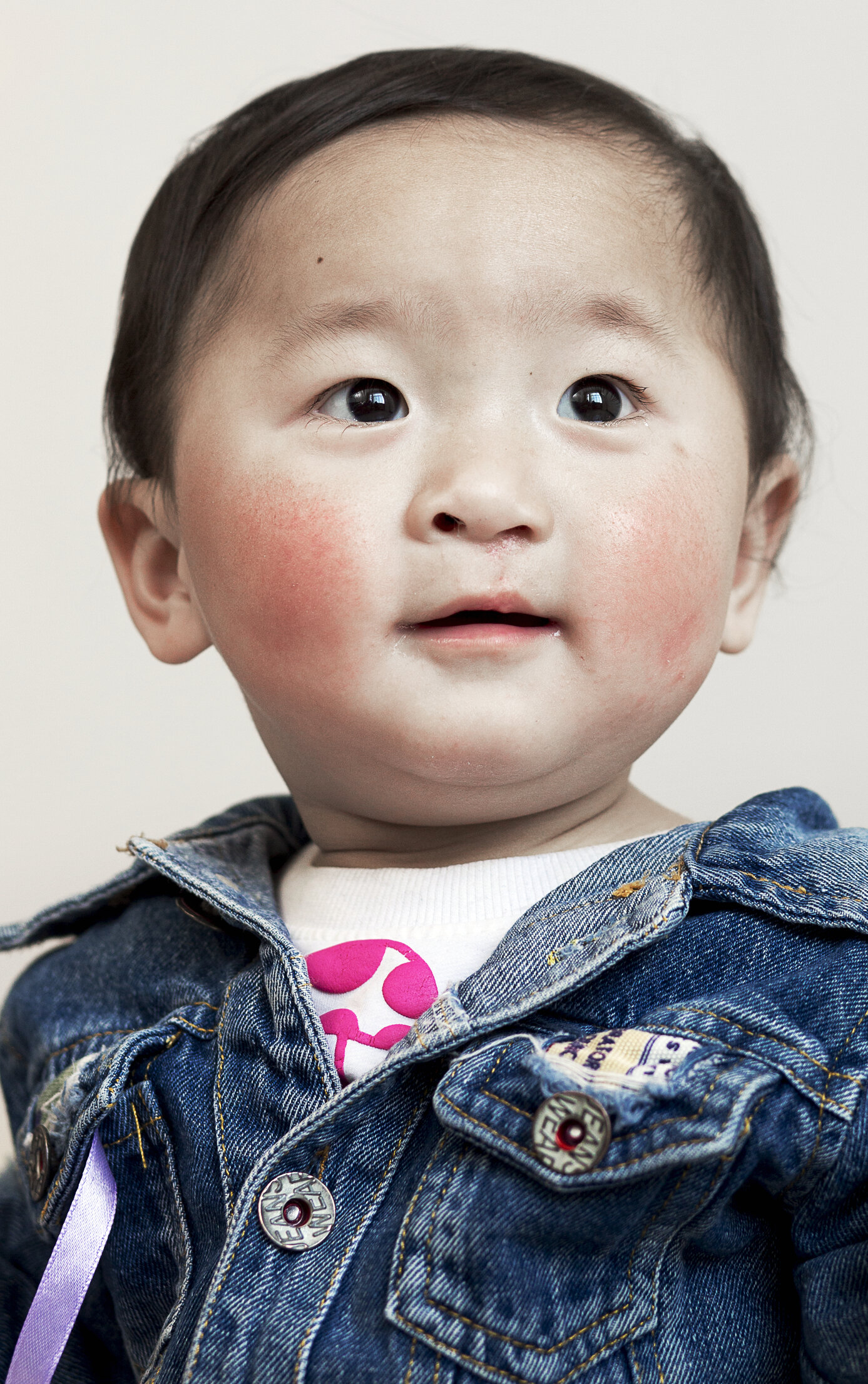 Yi Miang, after surgery.