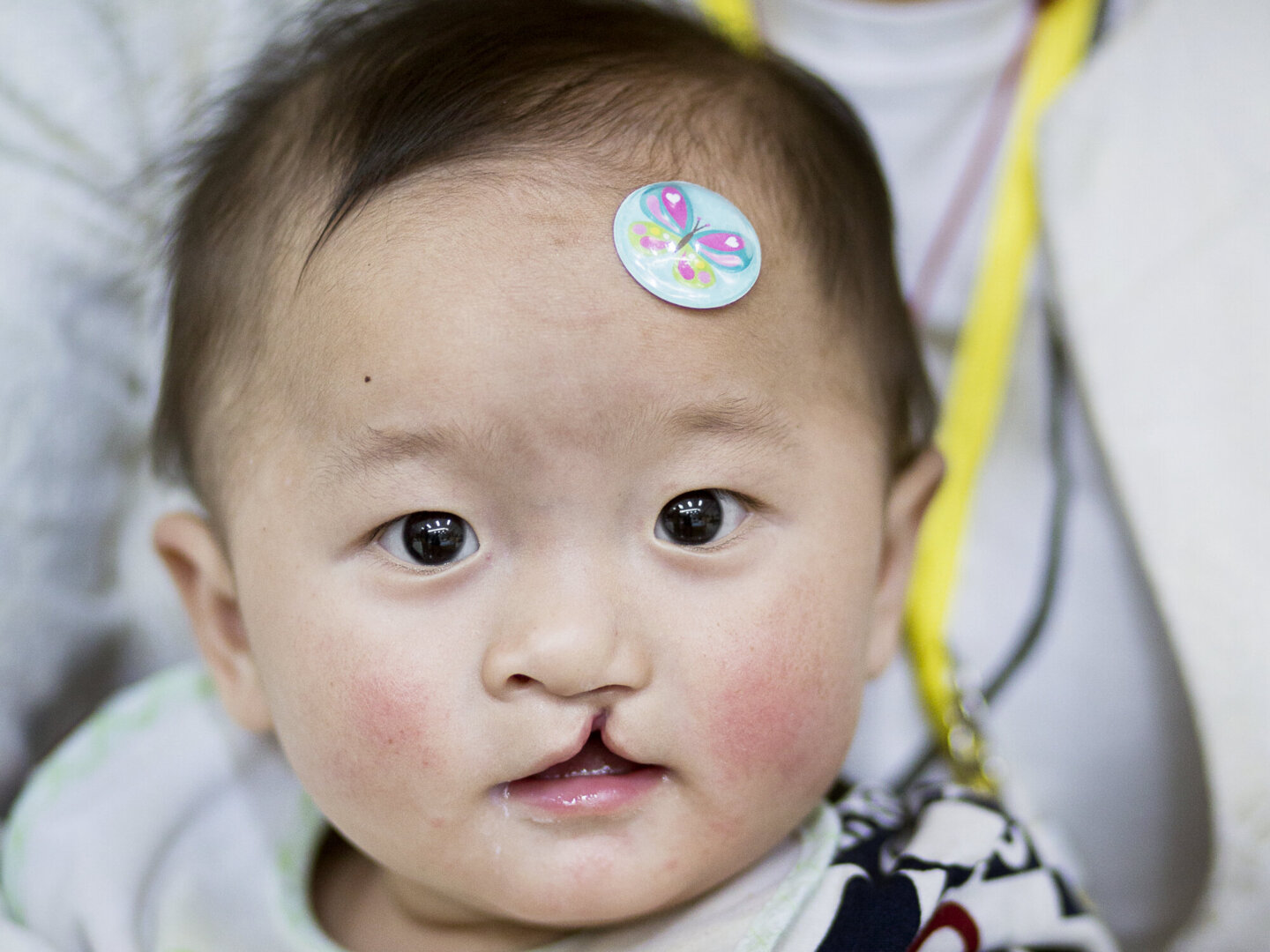 Yi Miang looks at the camera before surgery in 2016.