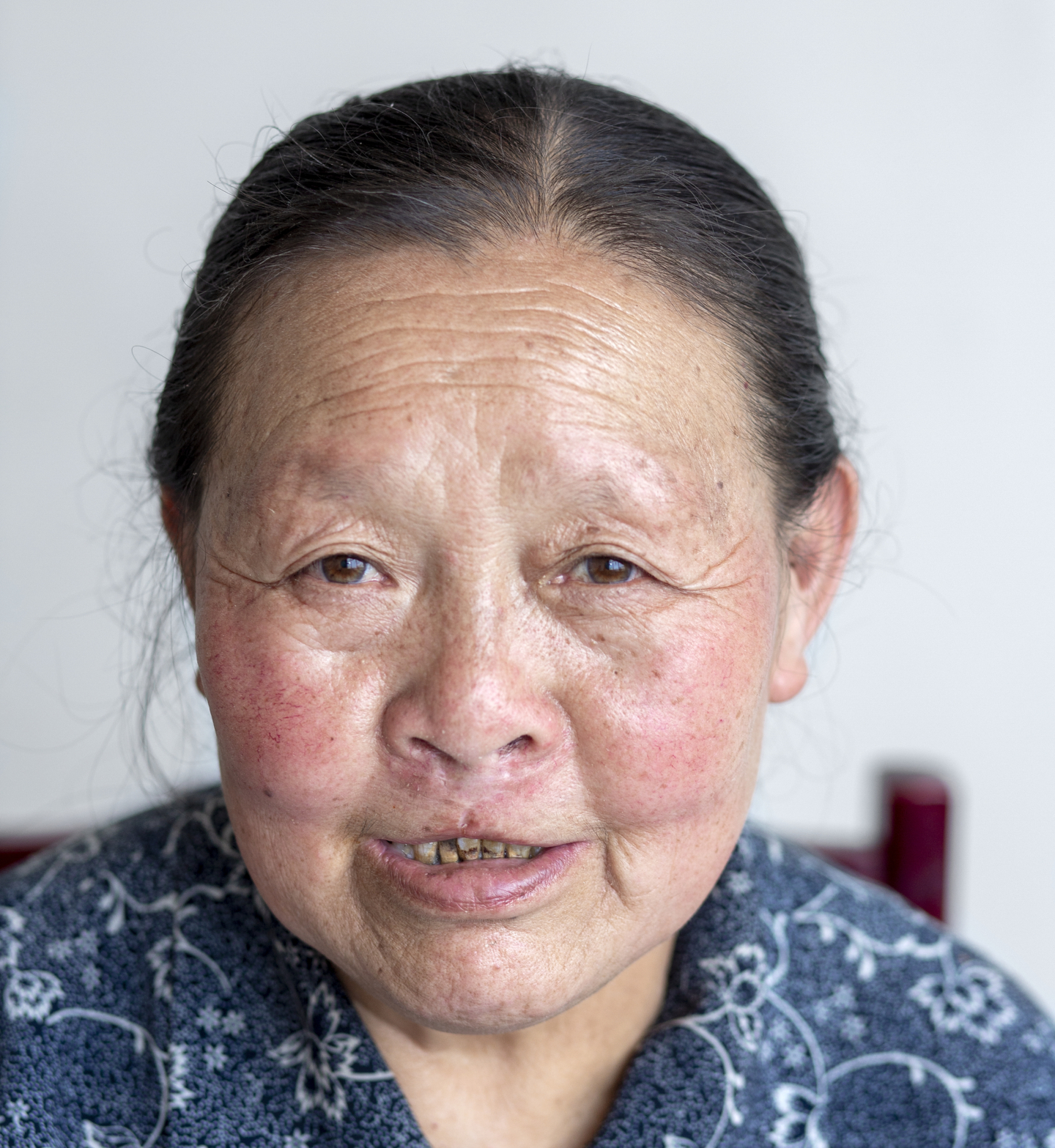 Qi Xiu, after surgery.