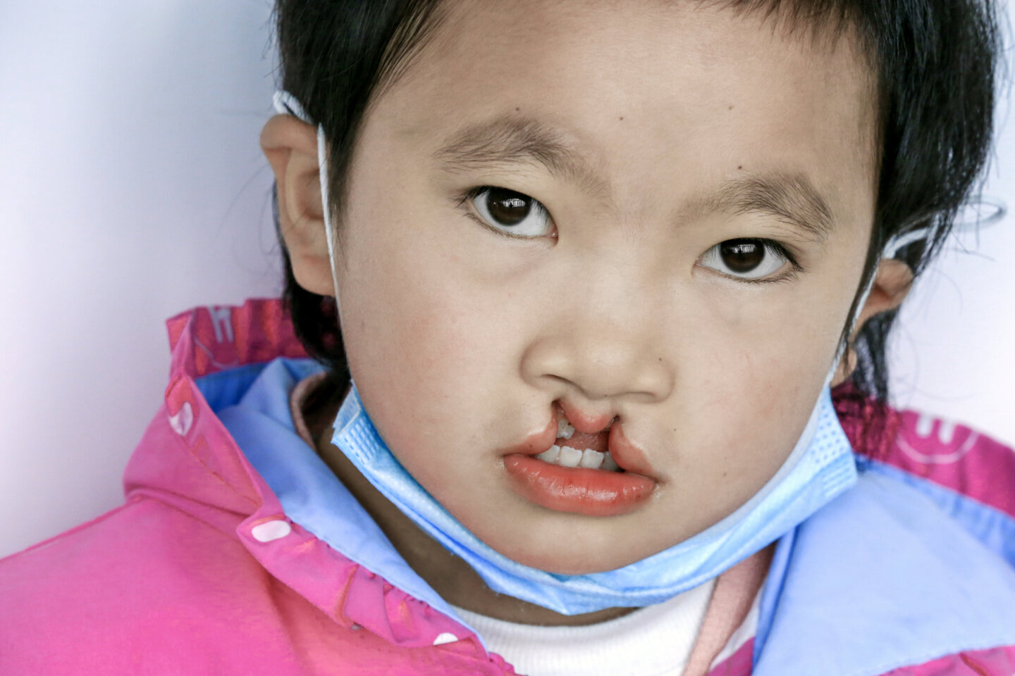 Yuanlin, before surgery.