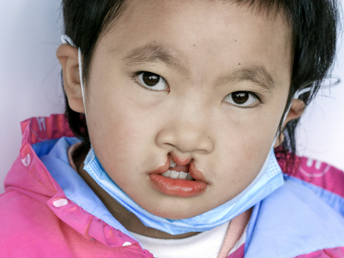 Yuanlin, before surgery.