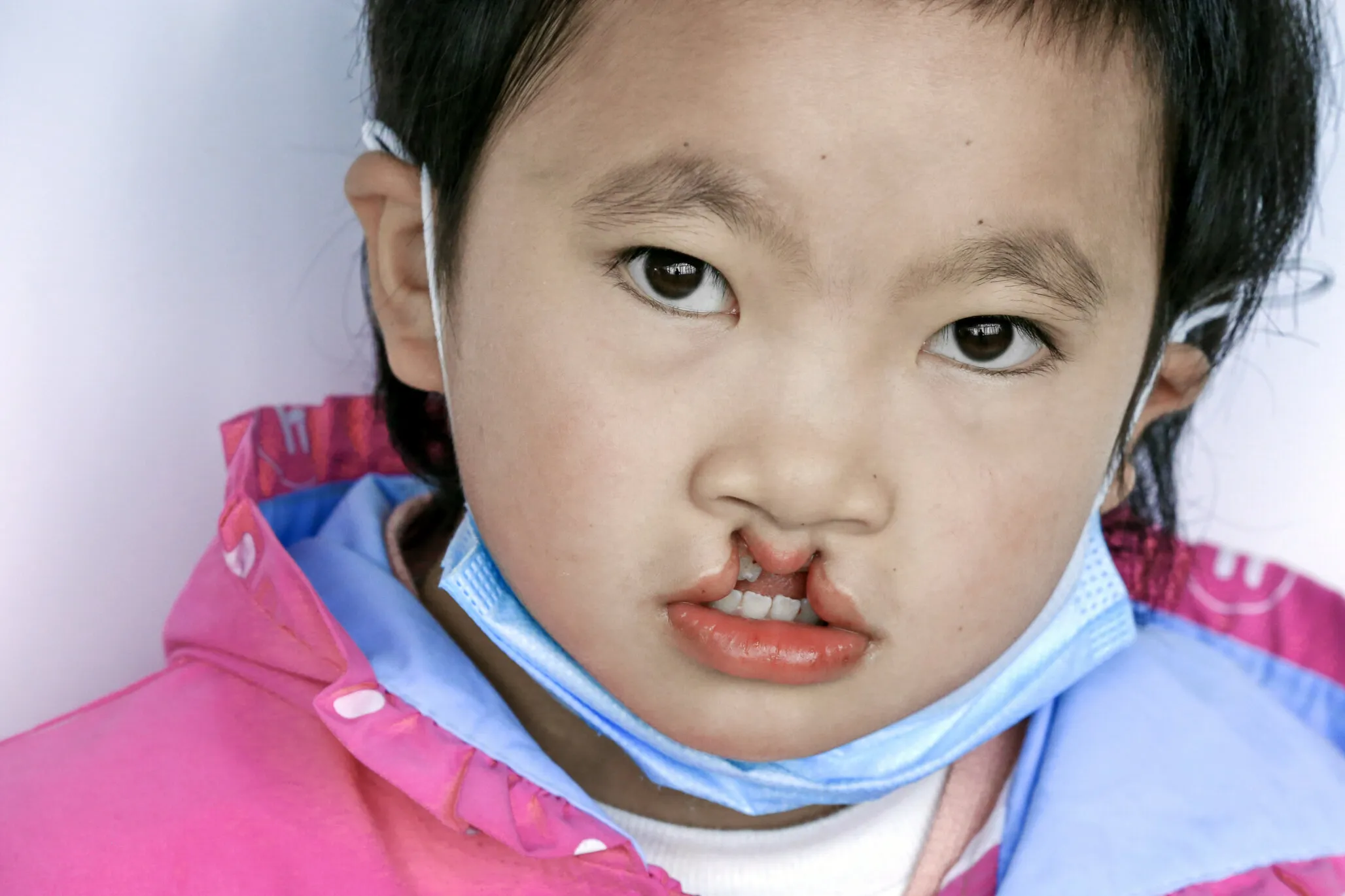 Yuanlin, before surgery.