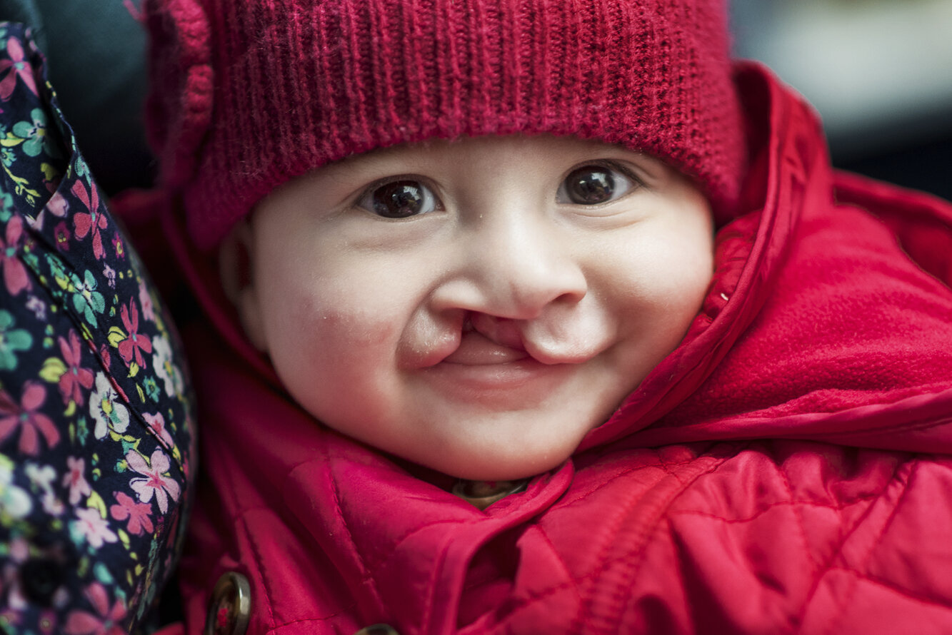 Luciana, before surgery.