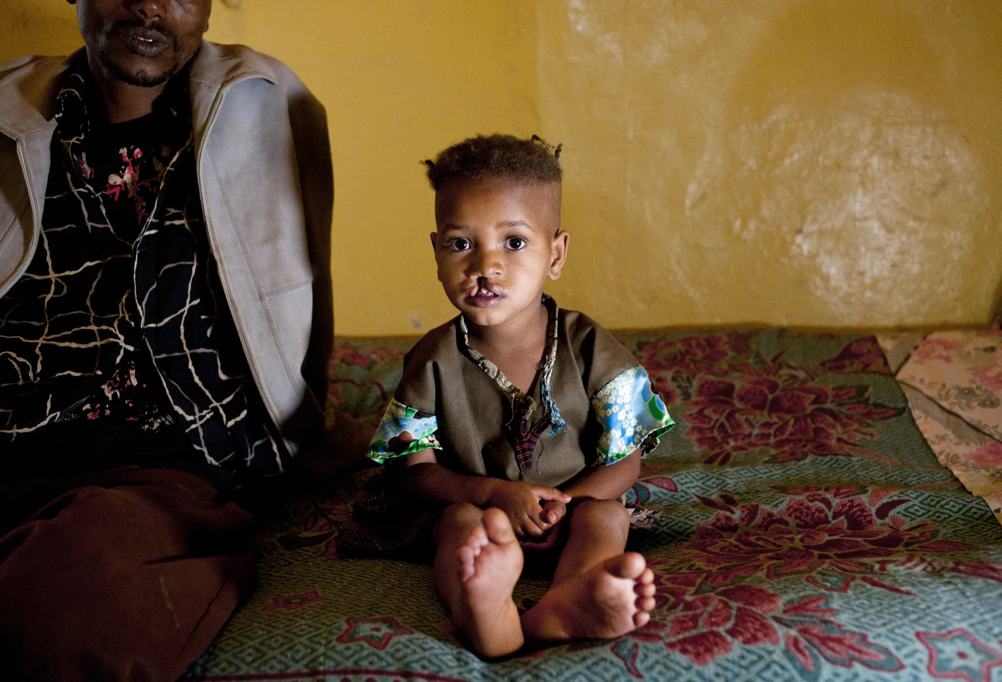 Four-year-old Nazifa, before surgery.