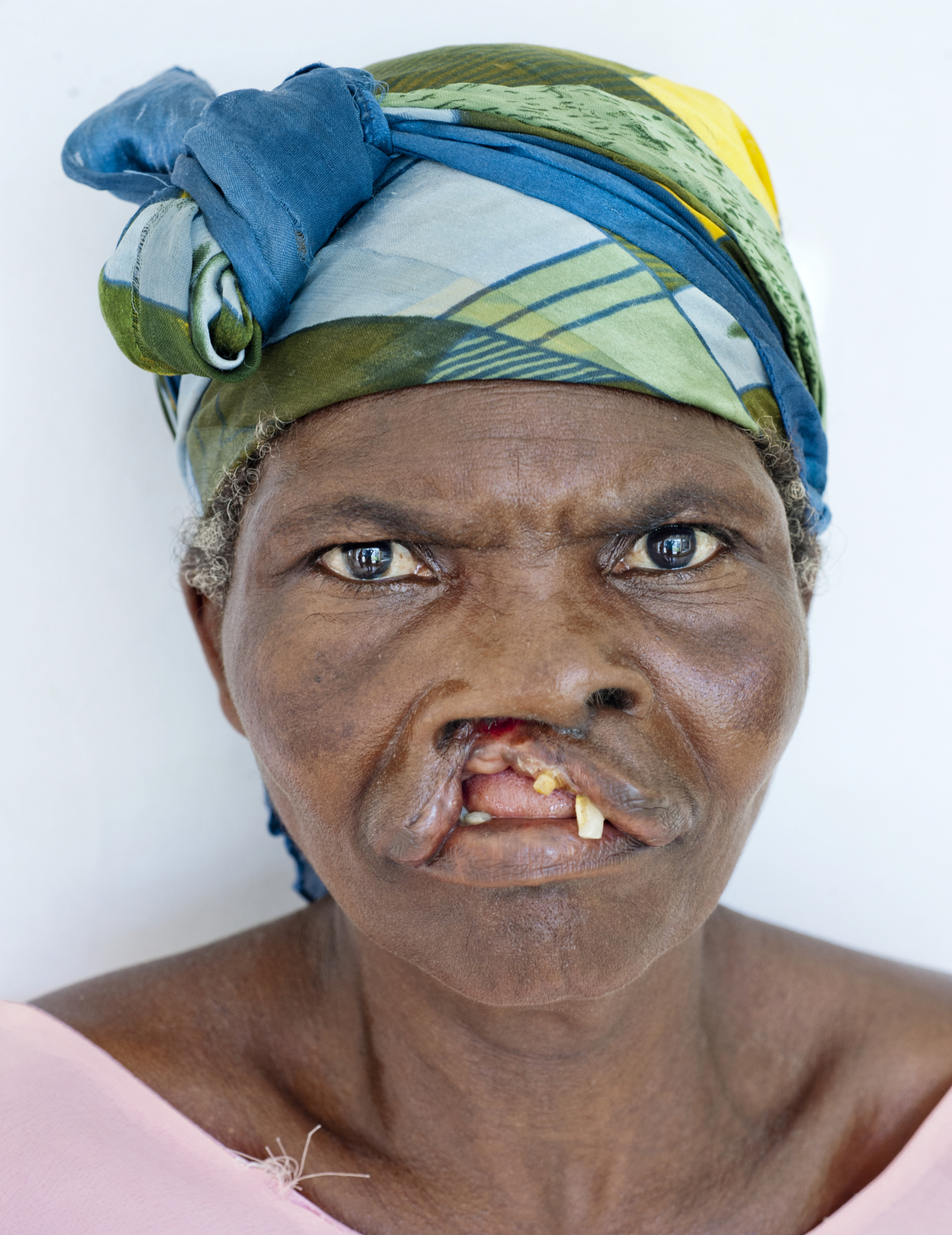 Yohana, before surgery.