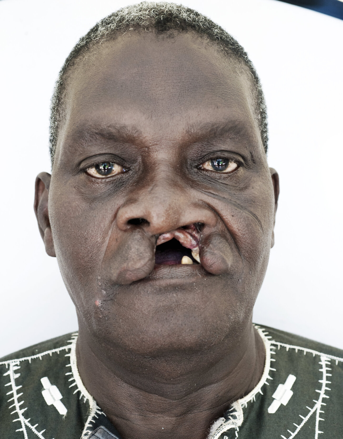 Iddrisah, before surgery.