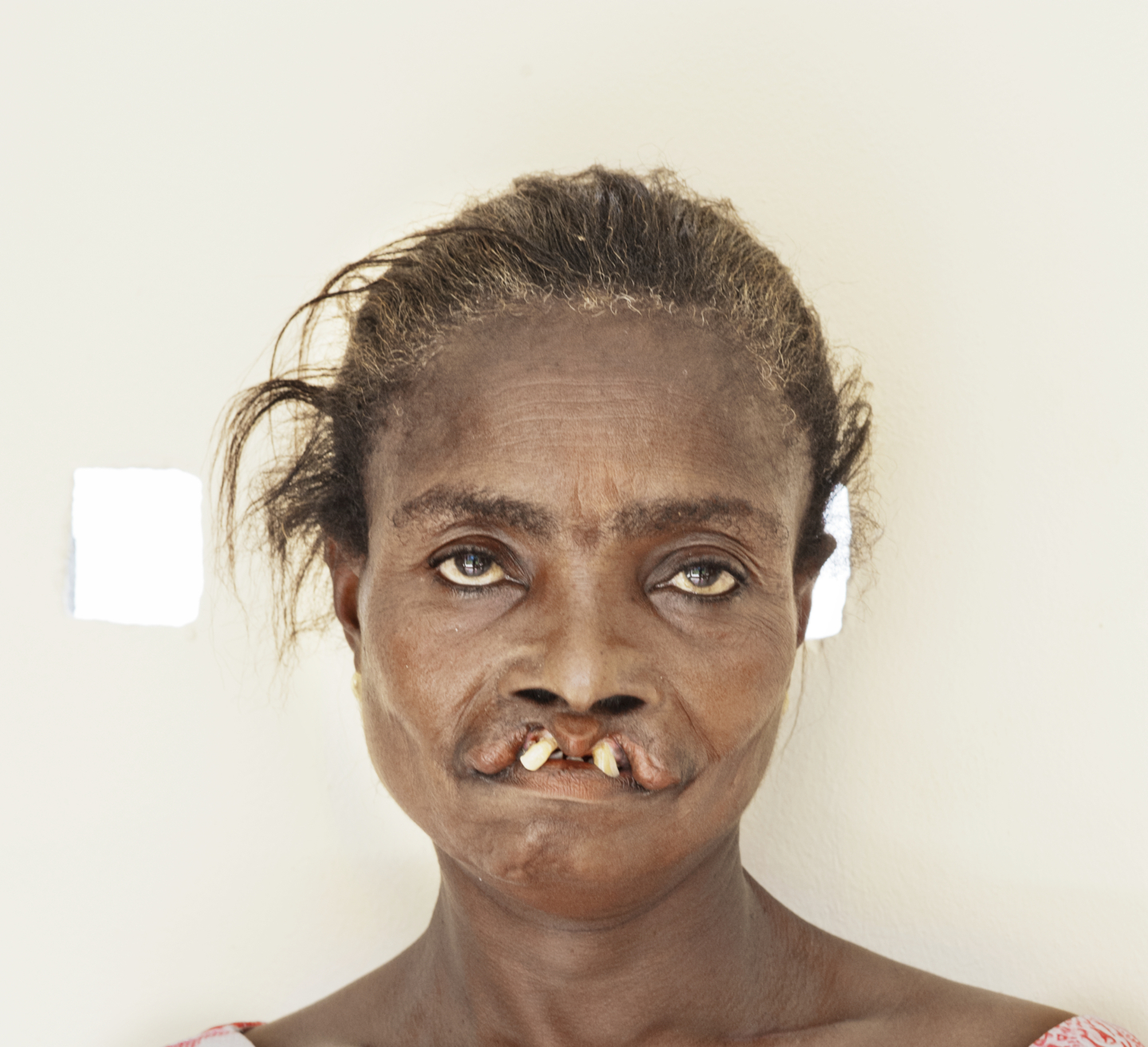 Akosua, before surgery.