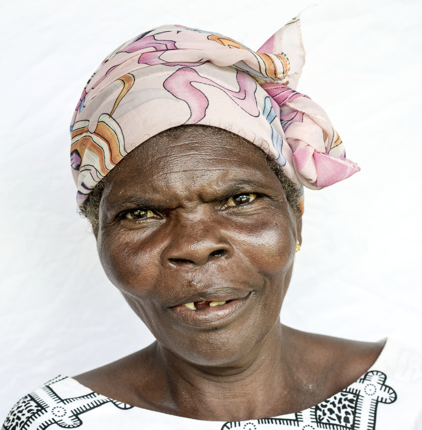 Yohana, one year after surgery.