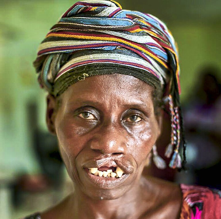 Esi, before surgery.