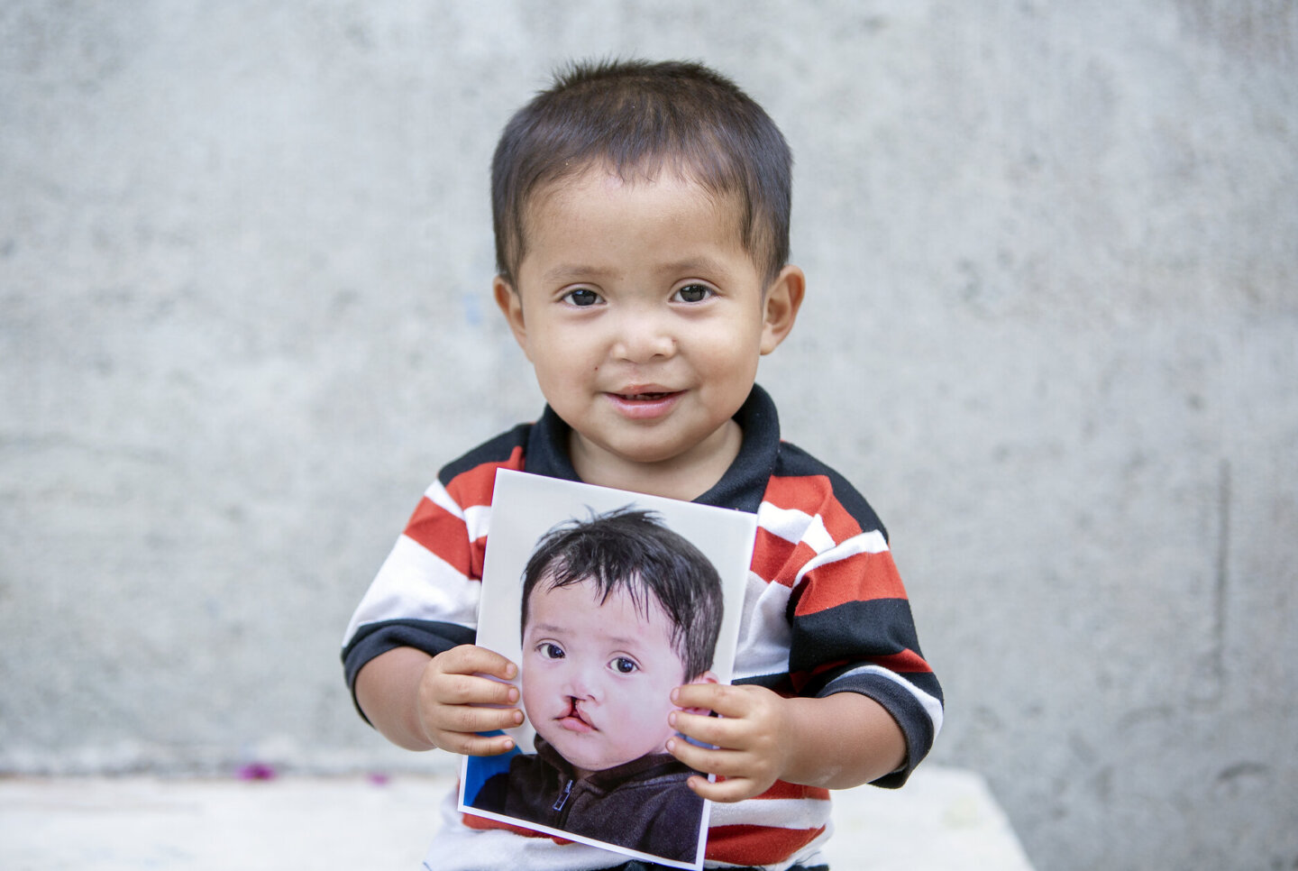 Brandon, after surgery, holds his before photo.