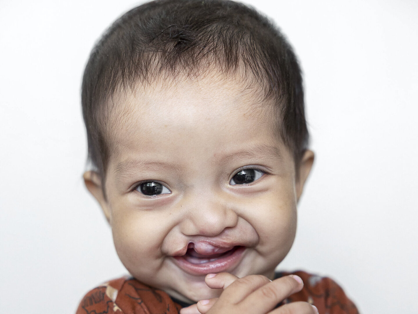 Edwin, before surgery.